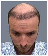 hair transplant albuquerque|Bosley Albuquerque .